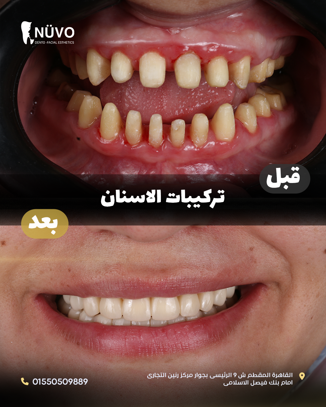 Dental Prosthesis