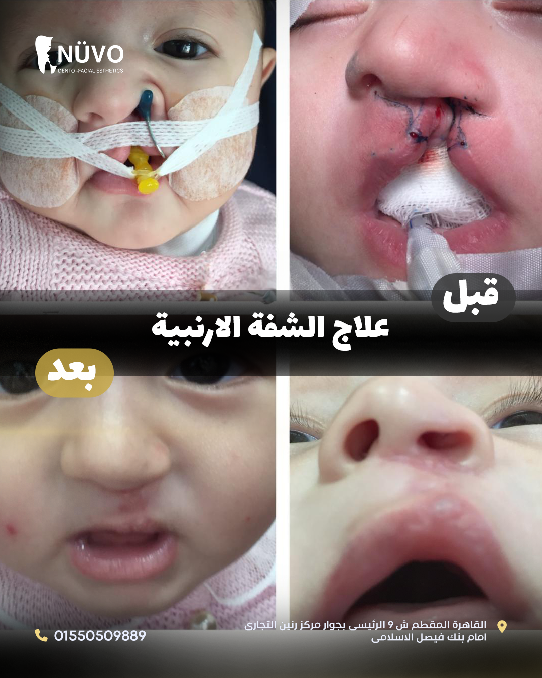 Cleft Lip and Palate Treatment (from Birth to Adulthood)